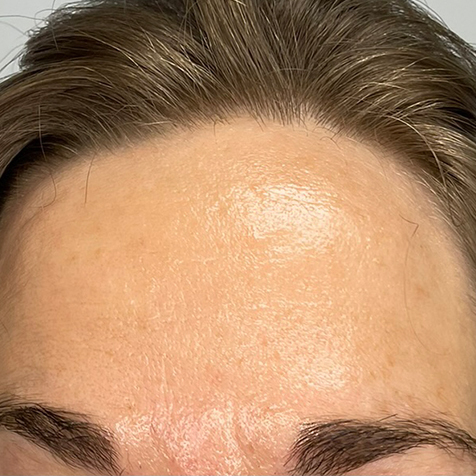 BIOBTX Nachher 4 Behandlungen hochgezogene Stirn